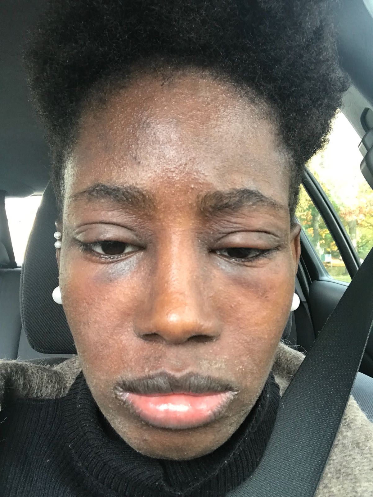 Joanne's swollen face