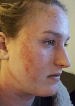 Side profile of a woman with a skin condition