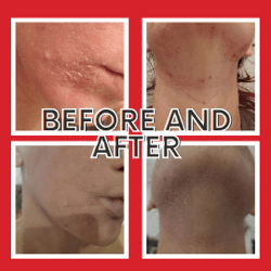 Before and after photos showing a persons improved skin condition