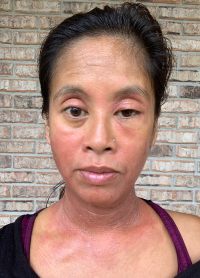 Raela suffering from an eczema flare and swollen eyes.